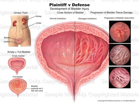 Bladder Damage - MotionLit