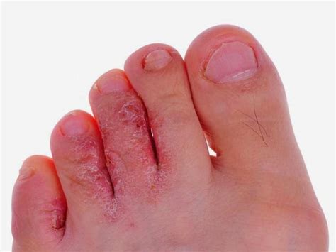 Doenças De Pele Causada Por Fungo - Biologia (alunos): Doenças causadas por fungos