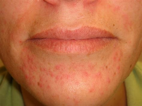 perioral dermatitis - DrBeckmann