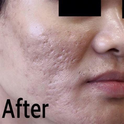 Does Laser Hurt? - Meridian Clinic