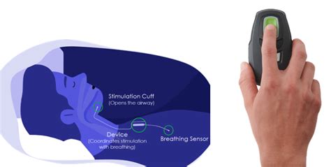 Inspire - Upper Airway Stimulation