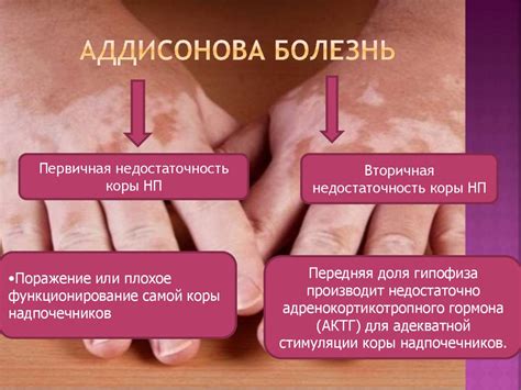 Аддисонова болезнь (бронзовая болезнь) - презентация онлайн