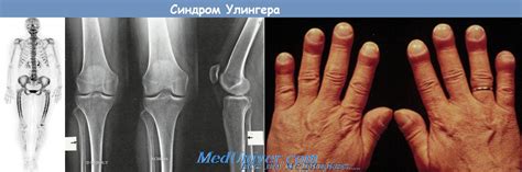 Синдром Улингера (Uehlinger) - синонимы, авторы, клиника