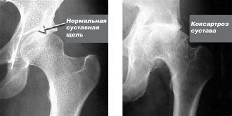 Трохантерит