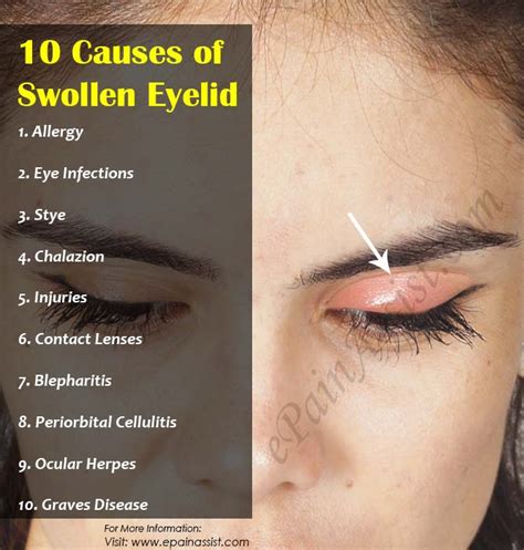 eye swell edema types  symptoms  treatment