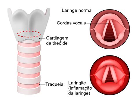 Laringite O Que Causa