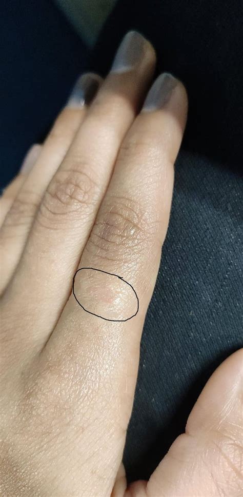 wore  silver ring   redness itching  small red colored