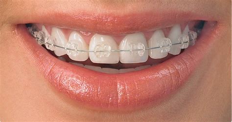 affordable dental care india teeth alignment  ceramic braces
