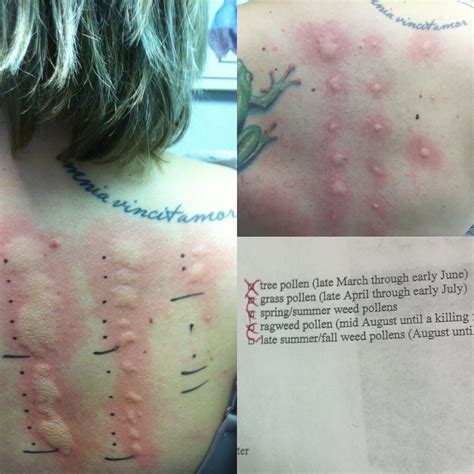 Is Skin Allergy Testing Dangerous at Sarah Bugarin blog