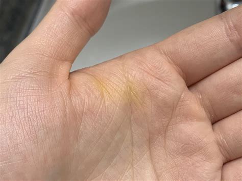 Woke up to this strange “streak” in my hairline, never had it before