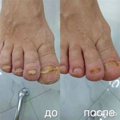 Подолог Педикюр Вросший ноготь Бородавки Мозоли в Москве | Услуги | Авито
