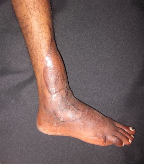 Ankle Fractures And Dislocations Different Types Of I - vrogue.co