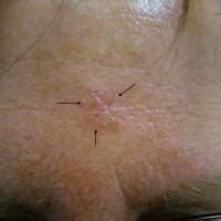Morphoeic basal cell carcinoma