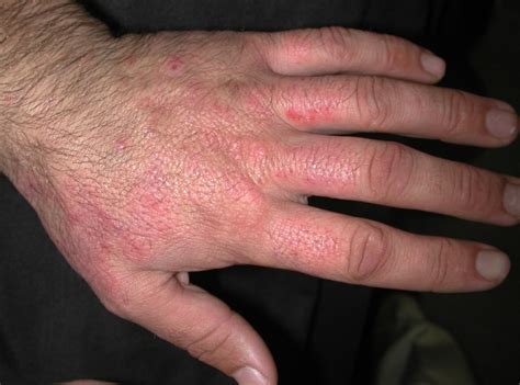 acd    skin irritant contact dermatitis icd