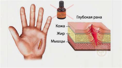Какую рану можно мазать йодом? Можно ли йодом обрабатывать открытую ...