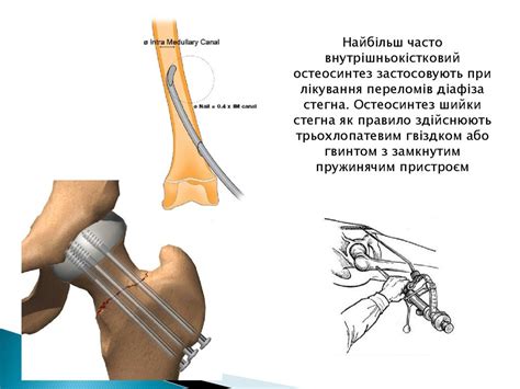 Остеосинтез - презентация онлайн