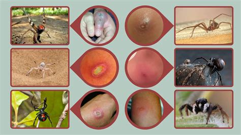 7 Most Deadliest Spiders on Earth: Bite, Symptoms & More