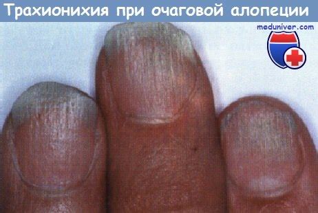 Очаговая алопеция у женщин: лечение - эффективные методы лечения