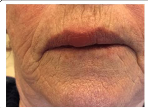 swelling   medial portion   upper lip  scientific