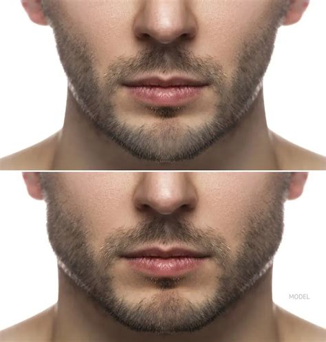 Jawline Filler Cost London | Dr Horlick Aesthetic