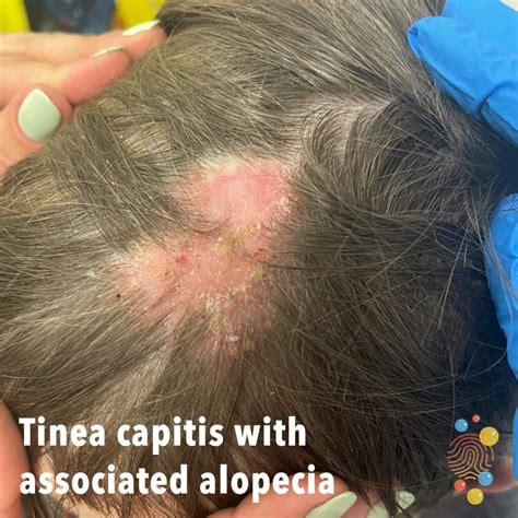 Tinea capitis - Skin Deep