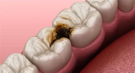 Enfermedades bucales; ¡Aprende a prevenirlas! | Periodontium