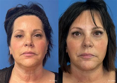 facelift neck lift   gallery