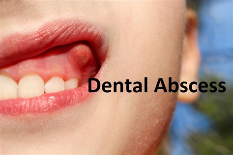 diagram diagram  abscess mydiagramonline