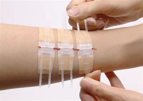 laceration wound closure device  pcs