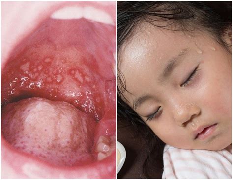 herpangina baby symptome herpangina bei kindern erwachsenen wacx