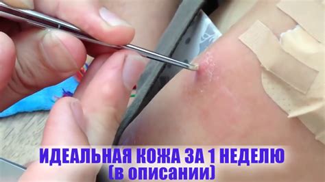 ОГРОМНЫЕ ЧЕРВИ ПОД КОЖЕЙ ДЕВУШКИ, УДАЛЕНИЕ - YouTube