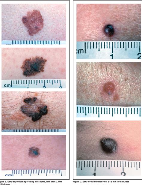 Figure 1 from Nodular melanoma. No longer as simple as ABC. | Semantic Scholar