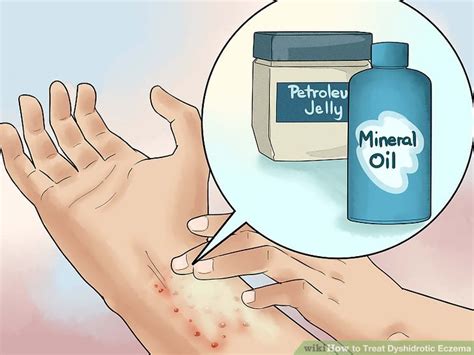 How to Treat Dyshidrotic Eczema: 12 Steps (with Pictures)