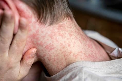 Sexually Transmitted Diseases (STD) in Men: Symptoms, Causes, Types