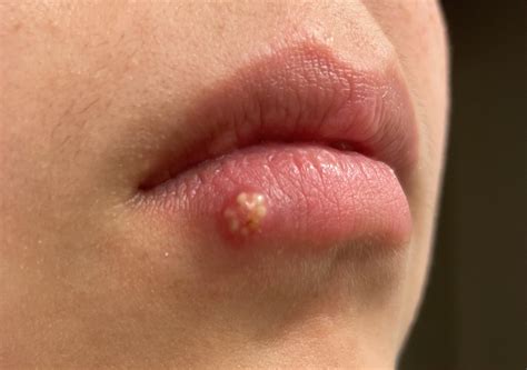 You'll Be Addicted After Watching This Pimple Pop! (New)