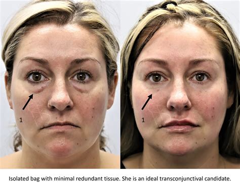 Brow & Forehead Lift Montgomery AL | Alabama Surgical Arts