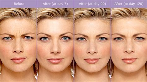 botox laugh  reduction plastic surgery pasadena burbank ca