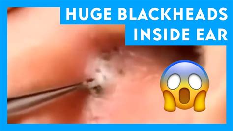 Huge Blackheads Inside Ear || Cyst and Blackheads - YouTube