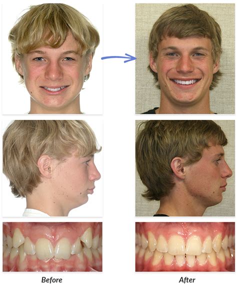 Braces Pics Before And After Braces Change Your Face Shape: Before And