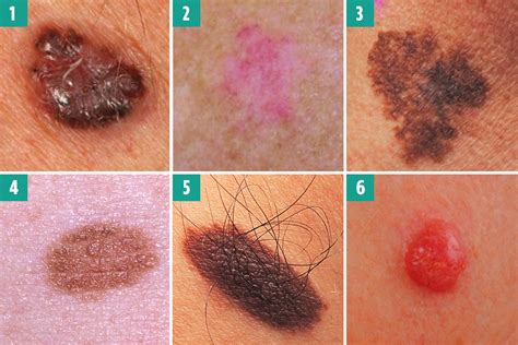 Can you spot the deadly moles from the harmless ones? The skin cancer ...