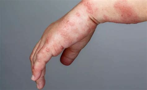 Eczema Recovery Tips | What To Expect After Treatment