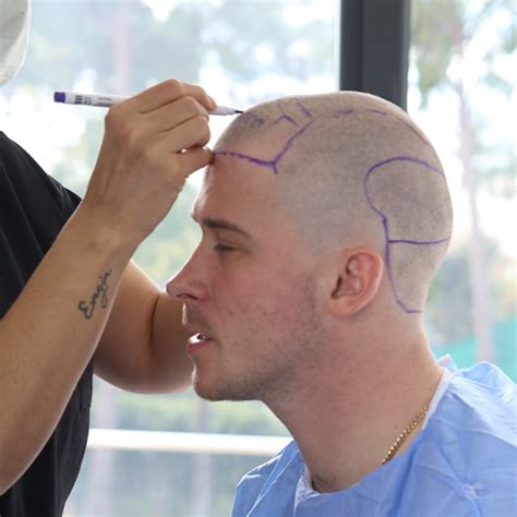 FUE Hair Transplant Cost in Turkey - Medworld Hair