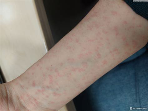 Антидепрессант Biocodex Стрезам - «Макулопапулезная сыпь» | отзывы