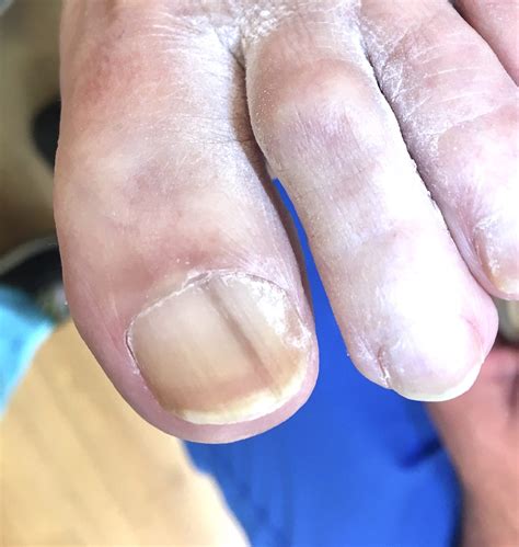 Dark Vertical Line On Nail