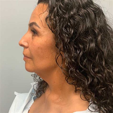 Before & After Laser Liposuction BeautiFill in Murrieta CA | Lucali
