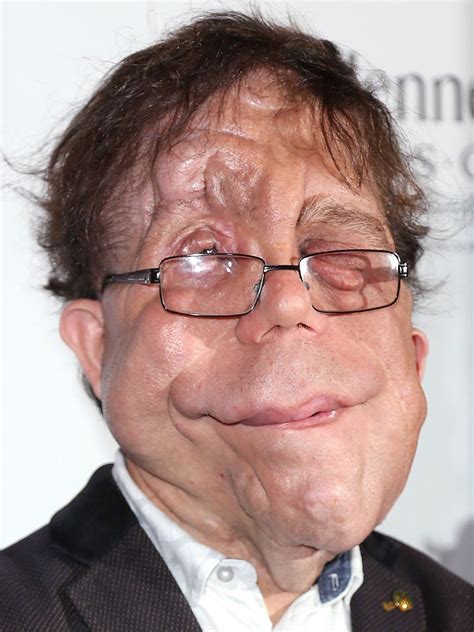 Adam Pearson Pictures | Rotten Tomatoes