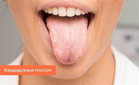 Воспаление сосочков на корне и кончике языка: причины увеличения, лечение