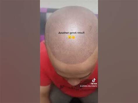 Scalp Micro Pigmentation Скалп Микро Пигментация - YouTube