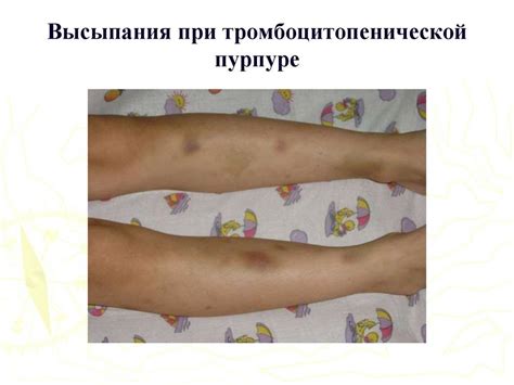 Кожный васкулит