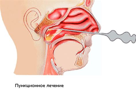 Как лечить гайморит в домашних условиях? Представляем рейтинг самых ...